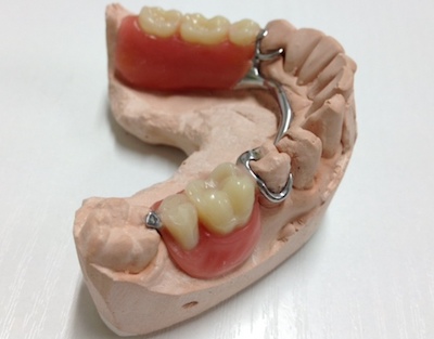Cast Partial Dentures